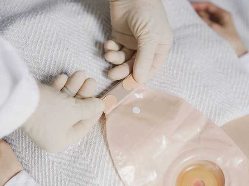 spletna trgovina z medicinskimi pripomočki z nasveti o negi stoma pripomočkov